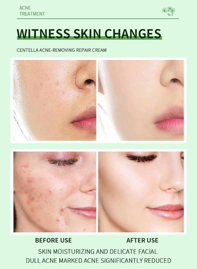 QANZIRE Acne-Removing Repair Cream, Acne Removal Acne Pimple Repair Cream, Natural Cystic Acne Treatment, Premium Acne Scar Cream And Pimple Remover (15g) - Image 3