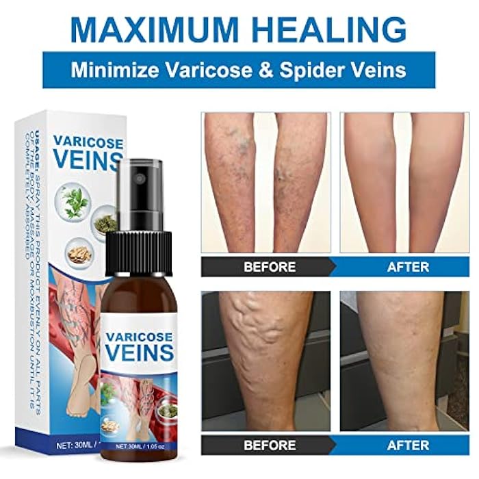EFINITYER Varicose Veins Miracle Spray, Varicose Veins Treatment for Legs, Improve Blood Circulation to Sooth Spider Veins and Relief Tired and Heavy Legs - Image 4