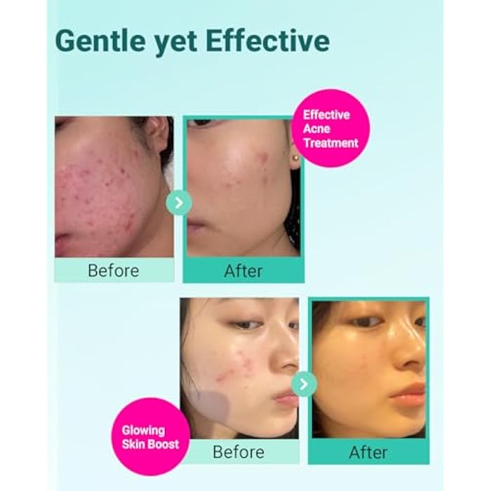 BRING GREEN TEA TREE CICA SET | Korean Skin Care Kit for Acne-Prone, Sensitive Skin | Zinc Teca Serum, Tea Tree Hydrating Moisturizer & Deep Cleansing Foam | Oil Control & Pore Care | K-Beauty Gift - Image 4