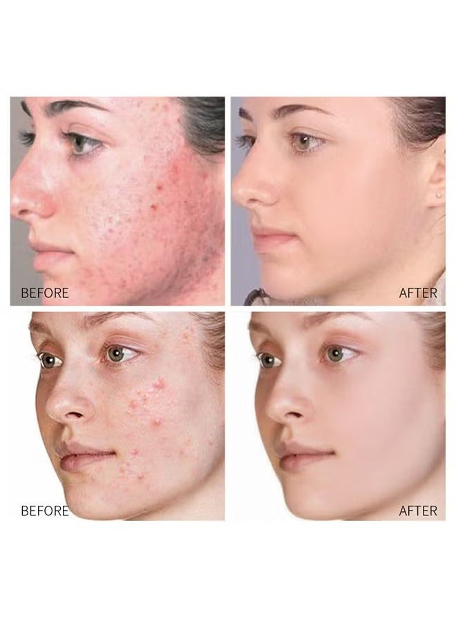 SOUTH MOON Acne Treatment Face Cream Acne Spot Treatment For Face And Acne Dots Natural Cystic Acne Treatment For All Skin Types Premium Acne Scar Cream And Pimple Remover 30ML  - Image 5
