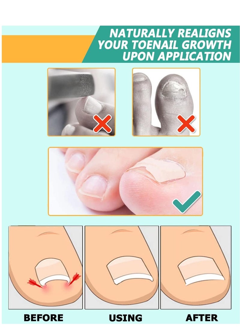 100 قطعة من ملصقات تصحيح الأظافر ، ملصقات تصحيح الأظافر المغروسة، شرائط تصحيح الأظافر الخالية من الغراء، علاج فعال لتصحيح الأظافر بدون ألم، يساعد في تخفيف أخاديد الظفر. - Image 4