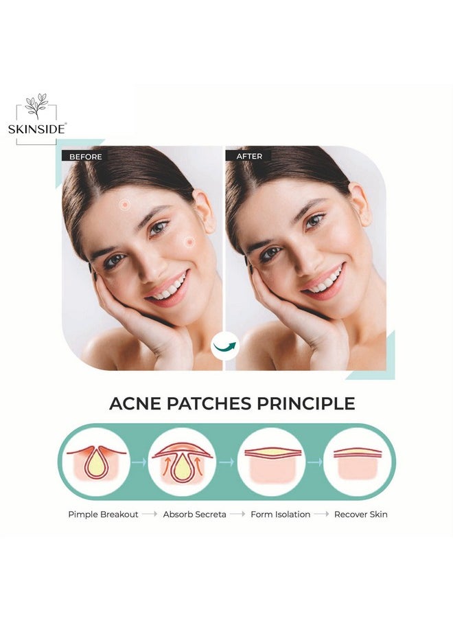 Skinside - Acne Pimple Patches For Face Pimples (72 Patches) Hydrocolloid Facial Patches With 0.5% Salicylic Acid For Pimple Healing | Invisible Waterproof Absorbs Excess Oil Overnight (72 Patches) - Image 1