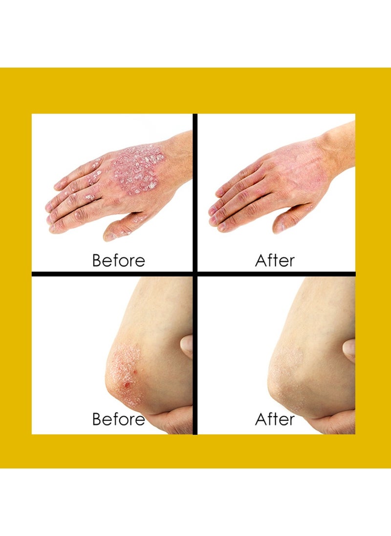 Suitable For Various Skin Conditions Such As Psoriasis, Eczema, Dermatitis, And Itching. 20g