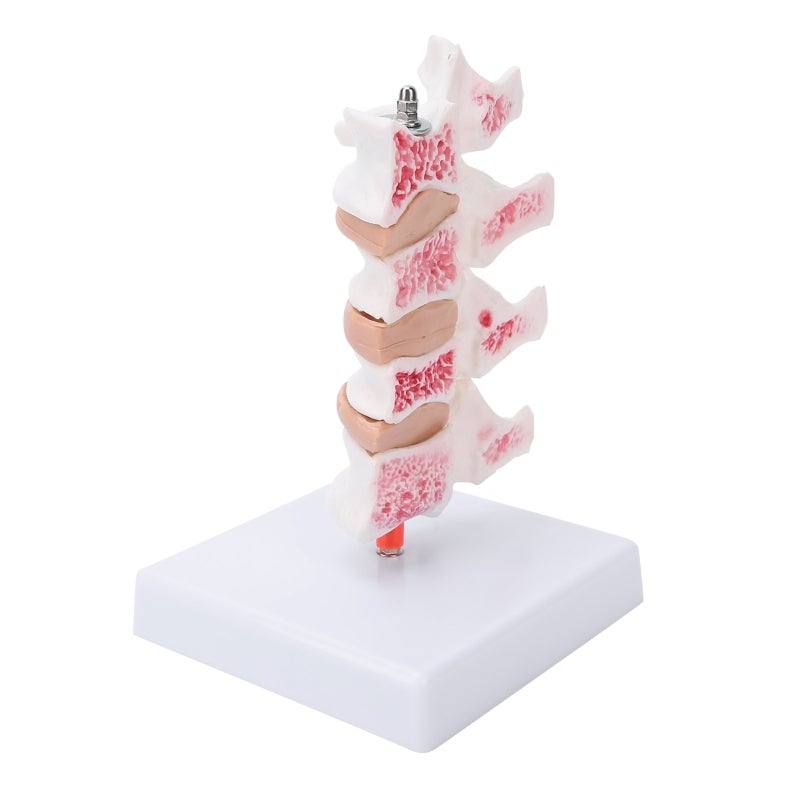 Human Anatomical Spine Model: High-Quality PVC Material, Durable - Pathological Changes Demonstration Professional Osteoporosis Model for Medical Teaching, Doctor-Patient Explanation - Image 1
