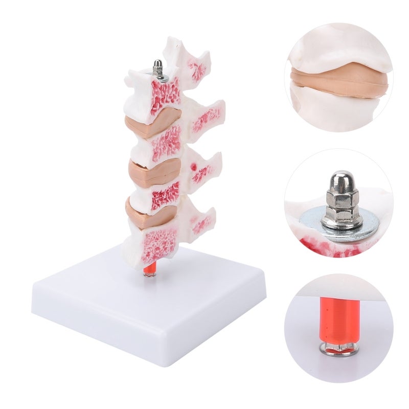 Human Anatomical Spine Model: High-Quality PVC Material, Durable - Pathological Changes Demonstration Professional Osteoporosis Model for Medical Teaching, Doctor-Patient Explanation - Image 3