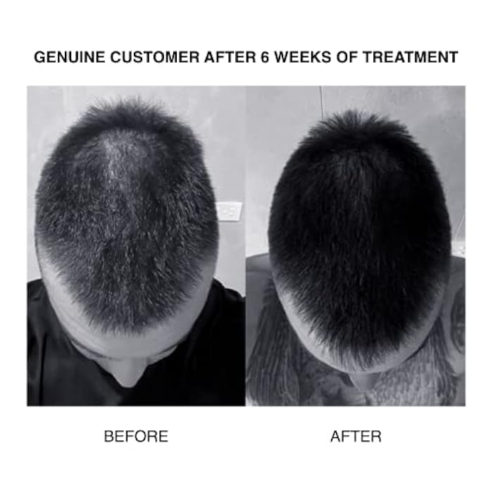 PATRICKS | CD Plus Ultra Thickening Conditioner | DHT Blocker | Includes Zinc & Powerful Ingredients to Support Hair Growth & Care | For Moderate to Advanced Hair Loss | 200mL - Image 4