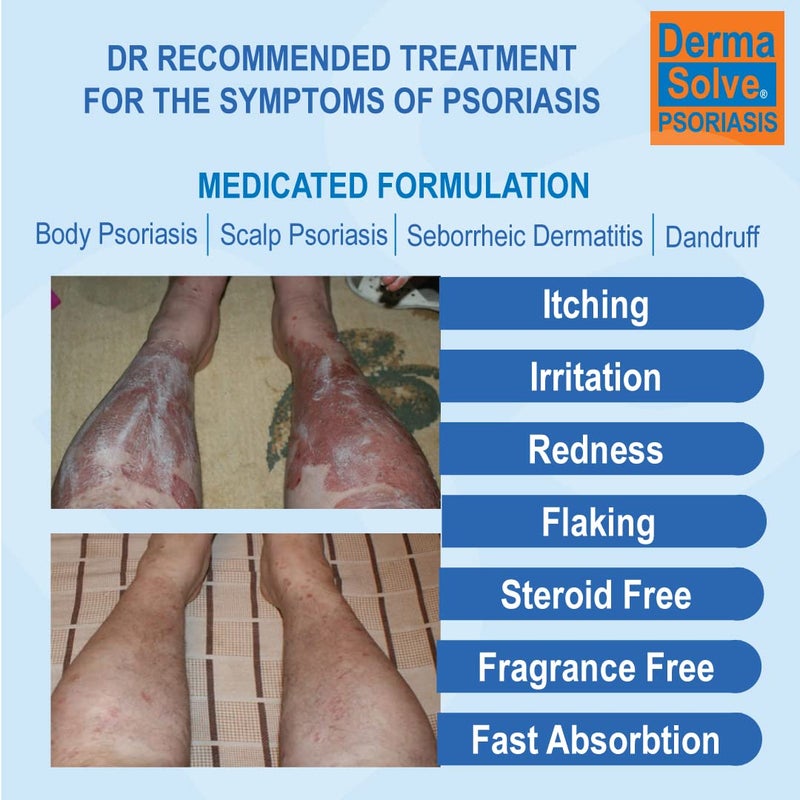 Dermasolve Psoriasis & Seborrheic Dermatitis Treatment Cream - Provides Intense Relief for Itchy, Flakey Skin and Advanced Moisturizing Prevents Future Flare-Ups 4.0 oz - Image 2