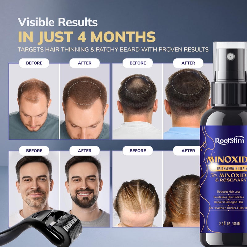 RootStim Minoxidil 5% Hair Growth Kit for Men and Women with Rosemary: Extra Strength Minoxidil Beard Regrowth Treatment Spray 2 FL OZ - Image 2