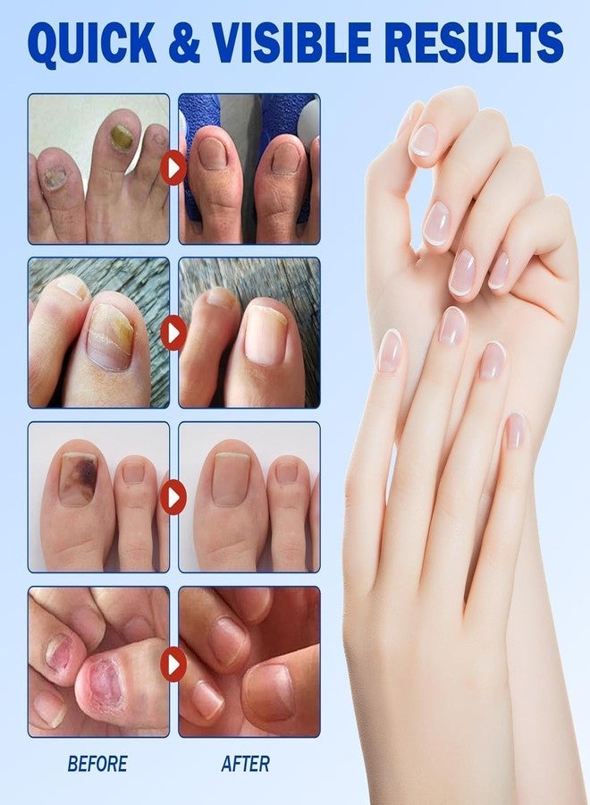 BUZZMEX New Advanced Fungal Nail Patch Treatment - Powerful Antifungal Solution | Targets Nail Fungus at the Root | Easy-to-Use Patch for Toenail & Fingernail | 20 Patches (pack-1) - Image 5