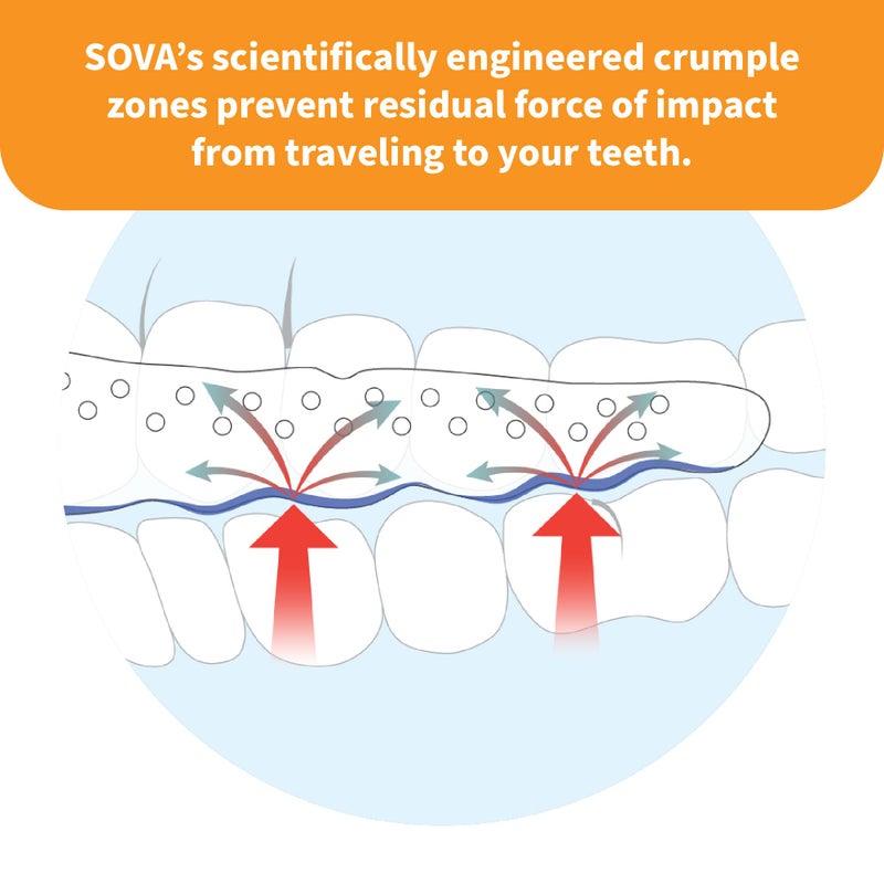 SOVA Junior Night Guard, Spring Green - 1.6mm Thin - Custom-Molded Fit - Protects Against Nighttime Teeth Grinding & Clenching - Odor & Taste Free - Remoldable Up to 20 Times - Image 5