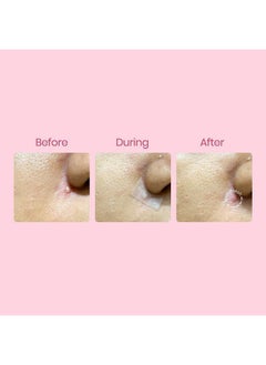 Spot Patch Free-Cut Korean Hydrocolloid Acne Pimple Blemish Patch Sheet (10Cmx10Cm)  - Image 3