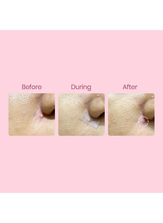 Spot Patch - Free-Cut Korean Hydrocolloid Acne Pimple Blemish Patch Sheet (10Cmx10Cm) - Image 1