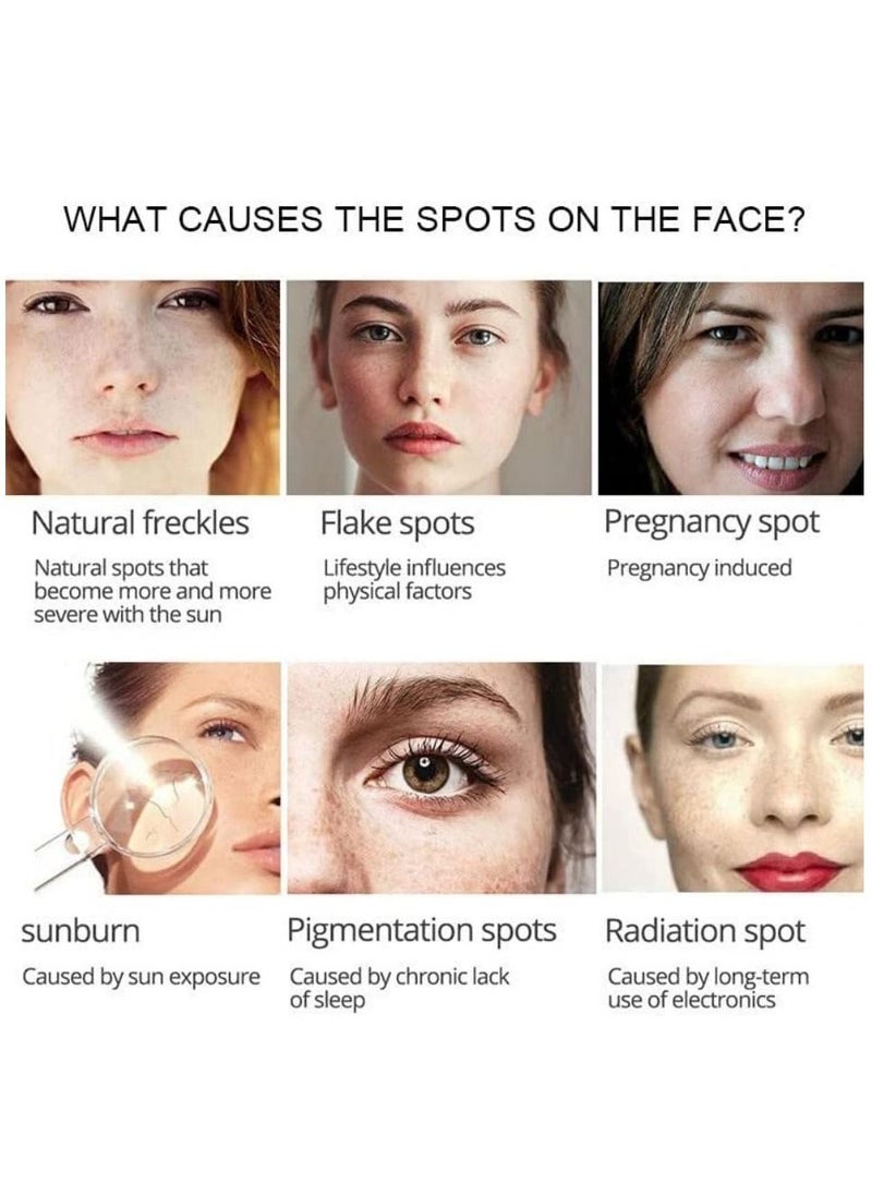 SNMLPM - High Efficiency Freckle Cream Freckle Remover Brightening Deep Moisturizing Dark Spot Corrector Melasma Cream For Men & Women 30g - Image 1
