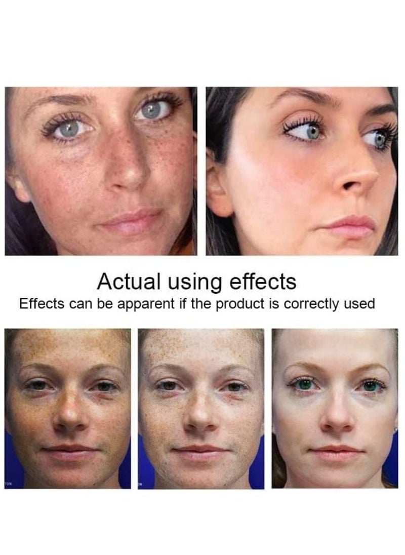 SNMLPM - High Efficiency Freckle Cream Freckle Remover Brightening Deep Moisturizing Dark Spot Corrector Melasma Cream For Men & Women 30g - Image 1
