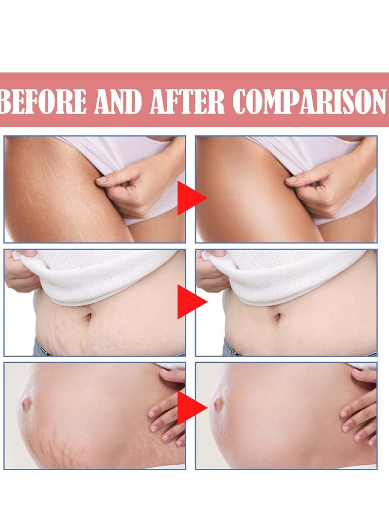 Scar & Stretch Mark Removal Cream for Pregnancy - Firming & Anti-Wrinkle Maternity Skin Repair, Acne Marks Treatment Body Lotion  - Image 4