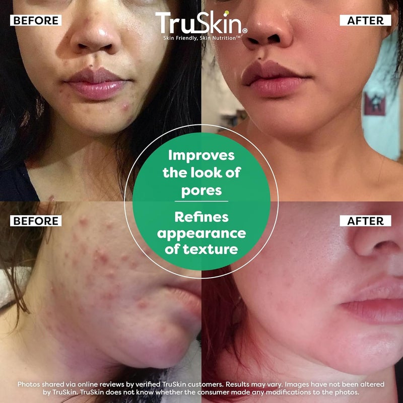 TruSkin Tea Tree Oil Acne Treatment for Face Acne Serum Improve the Appearance of Pores Skin Tone for Smooth Glowing Skin with Salicylic Acid Vitamin C Niacinamide Retinol 2 OZ - Image 4