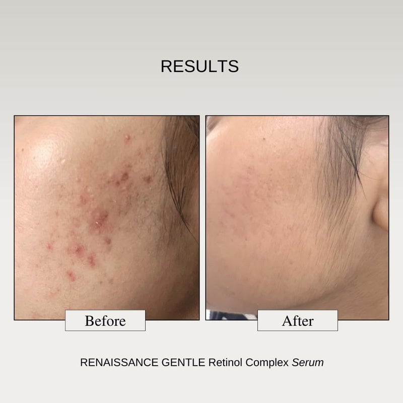 The Formularx 01 Retinol  05 Granactive Retinol Gentle Complex Serum With Niacinamide  Bakuchiol  For Acne Acne Marks Dark Spots Wrinkles  Pores  Anti Aging  Brightening Face Serum  30G - Image 4
