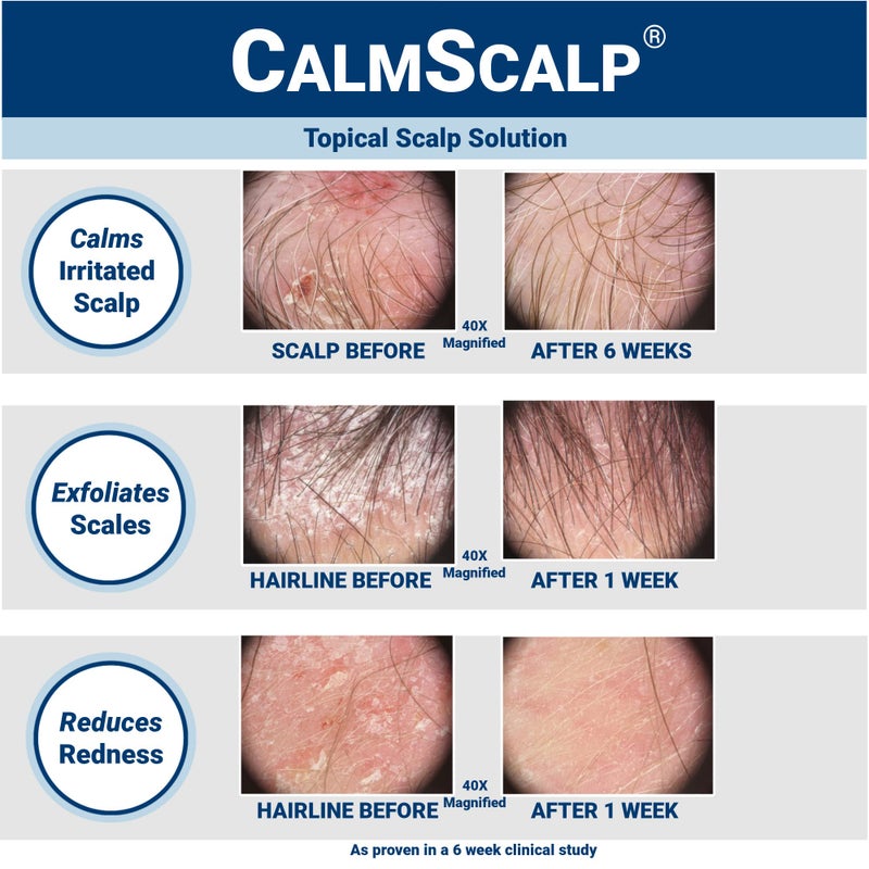 CalmScalp سيروم فروة الرأس CalmScalp | تخفيف حكة فروة الرأس | علاج فروة الرأس | يقشر القشور ورقائق الشعر | مثبت سريرياً | صنع في الولايات المتحدة الأمريكية | 4 أونصات - Image 2