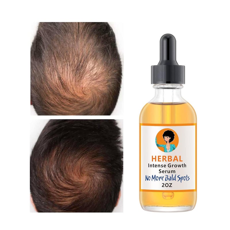 Ginger Hair Growth Serum  Treats Thinning Hair Loss Dry  Itchy Scalp Dandruff  Hair Regrowth Treatment for Men and Women  2OZ