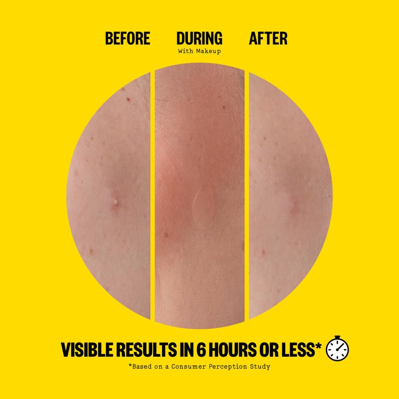 PEACE OUT Acne Day Dot, Sheer Acne Healing Dots, Virtually Invisible Wear, Hydrocolloid Pimple Patches Helps Clear Blemishes Quickly with Encapsulated Salicylic Acid, Retinol & Aloe Vera, 20 dots - Image 3
