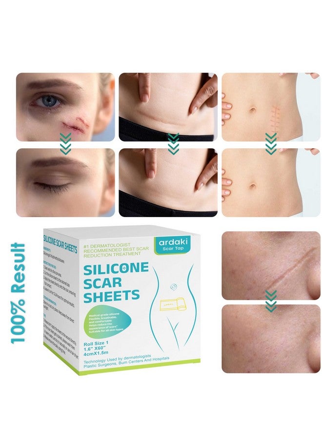 ARDAKI Silicone Scar Sheets,Silicone Scar Tape,Scar Tape For Surgical Scars,Silicone Scar Removal Strips For Surgical,C-Section,Tummy Tuck,Keloid Scars,Acne Scars, Reusable (1.6"X 60" Roll-1.5M) - Image 2
