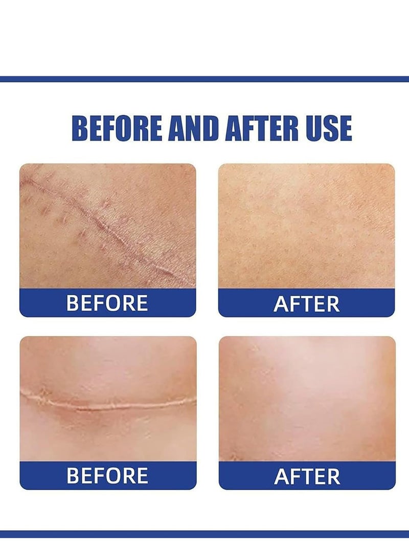 EELHOE BREAST Silicone Scar Sheets, Reusable Washable Silicone Scar Tape, Surgery Scars Removal Treatment, Medical Grade Silicone Scar Sheets for Breast - Image 5