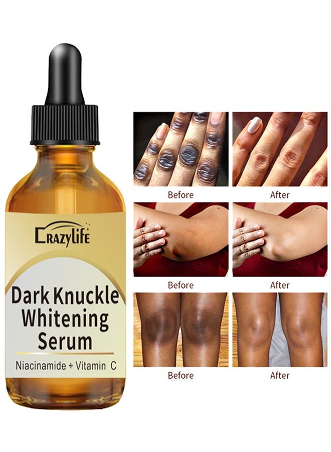 Crazylife Dark Knuckle Whitening Serum, Joint Darkening Serum, Acanthosis Nigricans Oil Dark Spot Corrector, Lighten And Repair Melanin, Skin Brightening Serum, Skin Care Removal Body Bleaching For Knuckle Elbows 30ml - Image 1