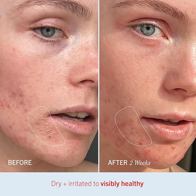 First Aid Beauty Ultra Repair Cream Intense Hydration Whipped Colloidal Oatmeal Clinically Proven to Strengthen Skin Barrier in 7 Days Helps Relieve Eczema Luxury Face Body Moisturiser 567g - Image 5