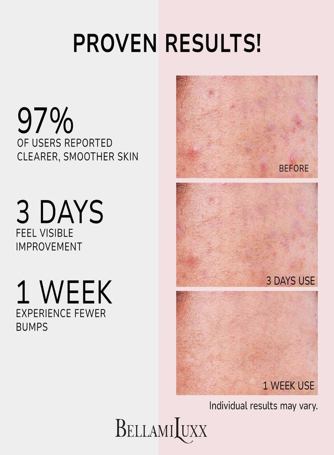 BellamiLuxx Butt Acne Treatment Set: Acne Soap Bar + Butt Treatment Lotion for Breakouts on Buttocks, Thighs, Back, Chest & Ingrown-Prone & Folliculitis-Prone Skin – Helps Reduce Body Breakouts - Image 4