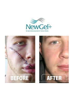 NewGel+ New Gel + E Advanced Silicon Gel for Scars 15 gm  - Image 2