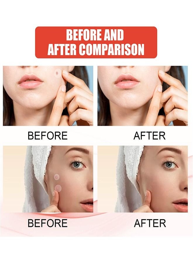 EELHOE 144 Pcs Hydrocolloid Acne Patche Set Healing Acne And Pustule Can Be Used Day And Night  - Image 5