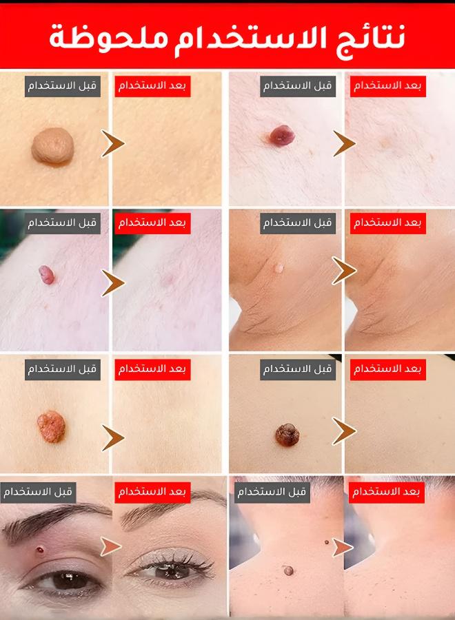 الهلياجيم جهاز العناية بالبشرة بالضوء الأزرق لإزالة الشوائب مع كريم إصلاح الندوب المجاني - Image 3