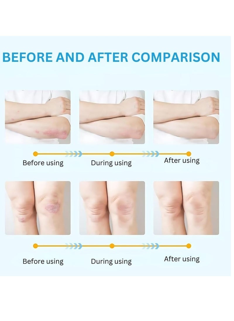 HEALMUSZ 100g Herbal Psoriasis Cream Antibacterial Psoriasis Cream with Herbal Ingredients for Relieve Psoriasis Skin Itching Inhibit Fungal Infection Psoriasis Treatment Cream Lotion  - Image 3