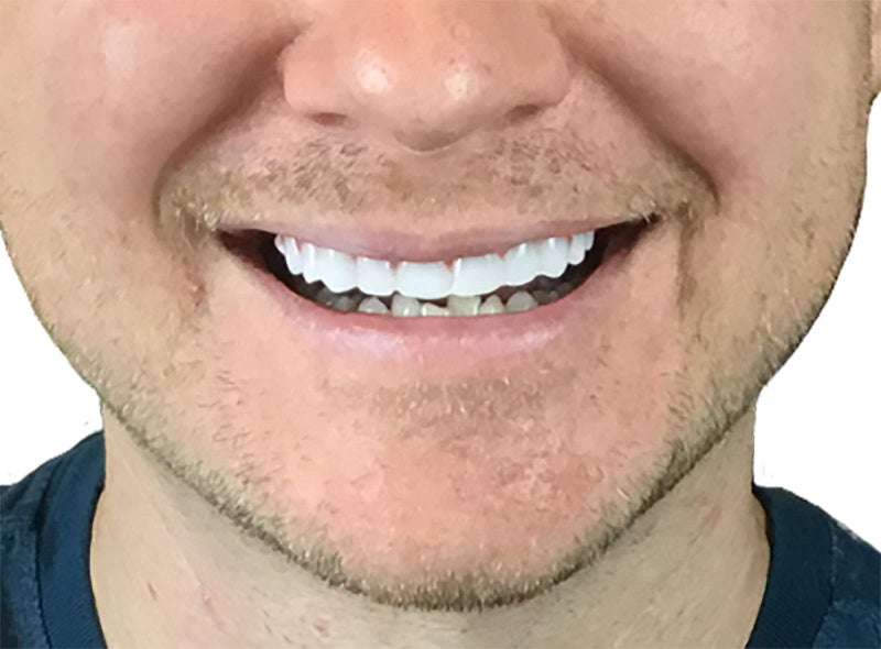 Instant Smile Flex 2pk - Bright White Shade - One Size Fits Most. Fix Your Smile at Home in Minutes! Comfortable Upper Cosmetic Veneer for A Perfect Smile! - Image 2
