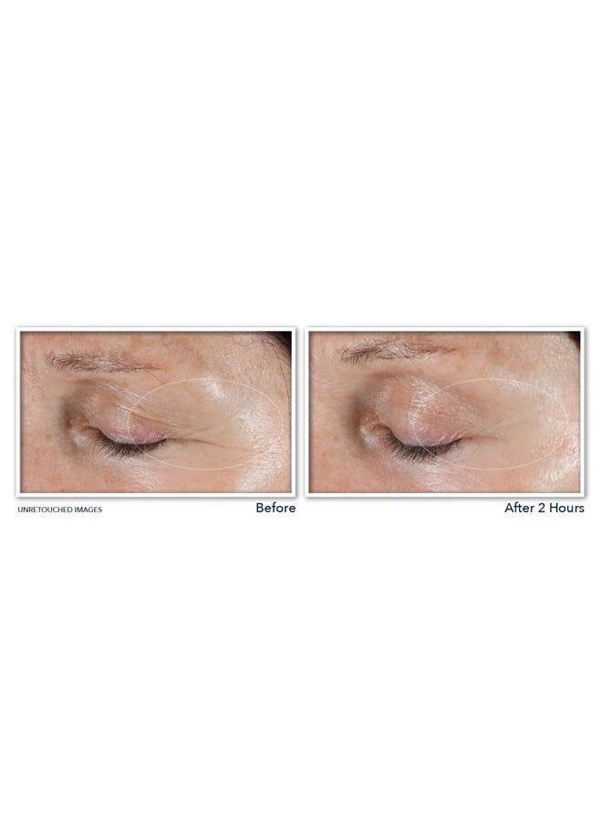 Retinol Correxion Deep Wrinkle Non-Invasive Targeted Patches with Hyaluronic Acid + Firming Peptides for Forehead, 11 Lines, Crow's Feet and Laugh Lines, (6 Patches) with Retinol Eye Packette