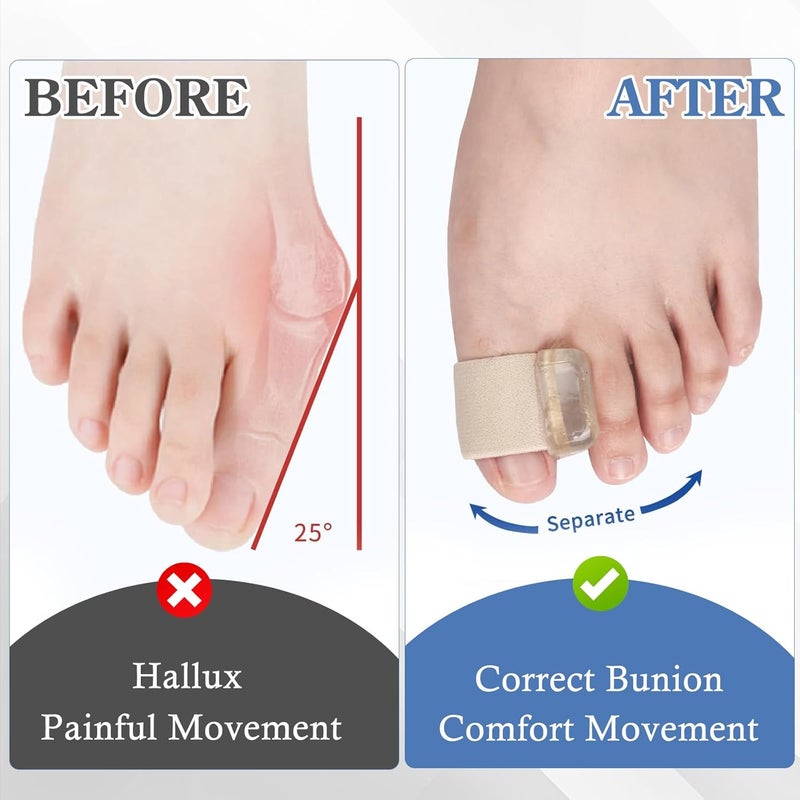 CoolShef 4 قطع فاصل أصابع القدم، مصحح بونيون للنساء، مستقيم أصابع القدم المريح للرجال، دعامة تخفيف إبهام القدم، فصل لطيف للراحة اليومية - لون البشرة - Image 5
