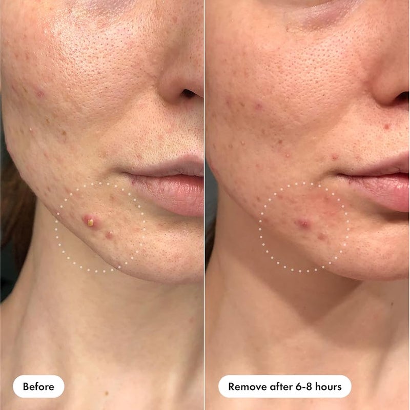 Mighty Patch Hero Cosmetics Invisible+ Patch – The Barely-There Hydrocolloid Acne Pimple Plaster for Covering Skin Imperfections and Blemishes, Conical Edges that Blend into the Skin - Image 3
