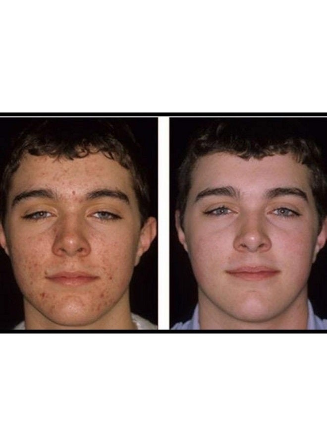 Acnetame Acne Pills- Vitamin Supplements for Acne Treatment- Natural Clear Skin from Hormonal Cystic Pimples- Oily Skin Vitamins Pill for Women, Teen, Men, & Adults 60 Tablets - Image 3