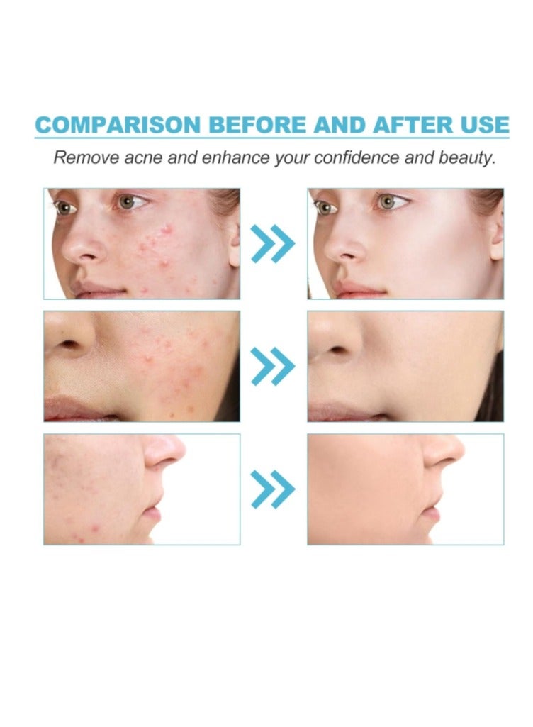MOOYAM Acne Treatment Gel,Anti Acne Removal Cream,Spot Cream for Acne,Spot Treatment for Face,Face Care Acne Cream,Acne Gel,Acne Scar Treatment,Daily Skin Care,Acne Moisturiser,Acne Scars Recovery 1Pcs  - Image 2