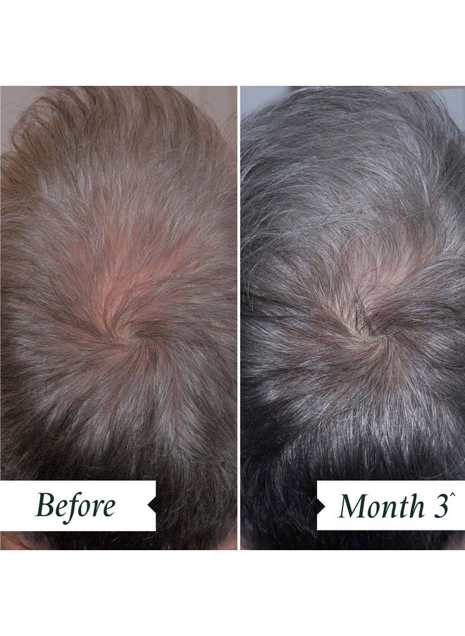 Philip Kingsley - Density Preserving Scalp Drops Hair Density Serum For Thinning Hair And Hair Loss Scalp Care Products For Hair Fall And Thickness 2.87 Oz - Image 1