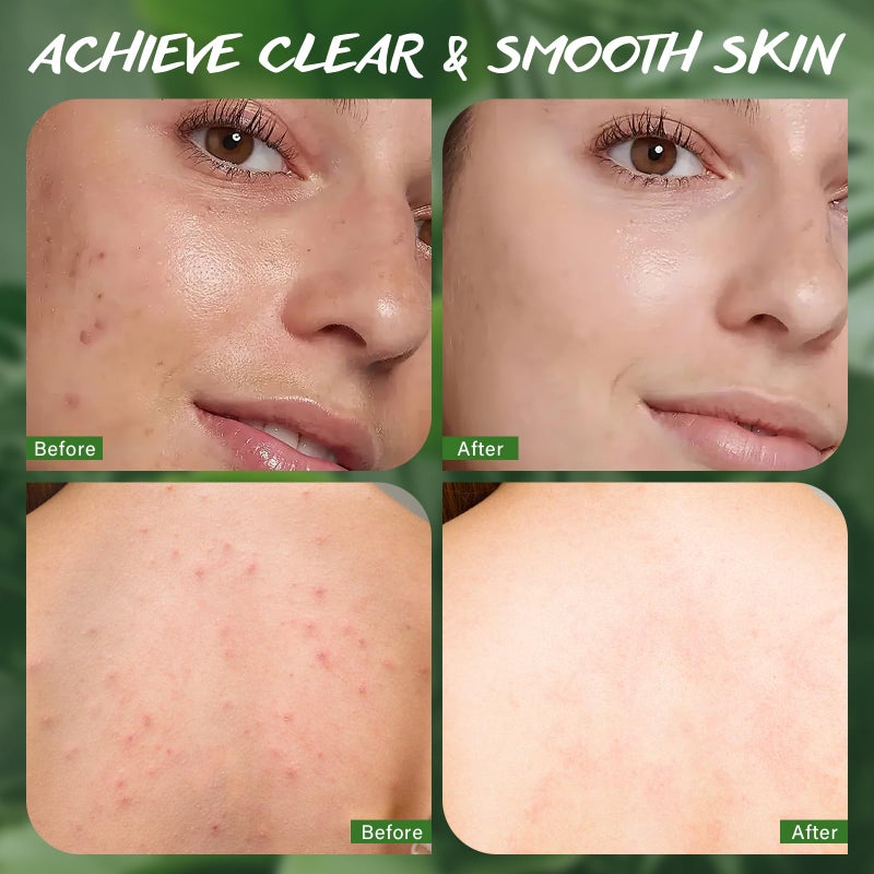 POP MODERN.C Tea Tree Oil Soap Bar for Face & Body Wash All Natural Organic Bath Soaps Acne Hand Foot Body Oder Moisturizer Plant Deodorant Facial Cleanser Women Men with Soap Holder Bag Scrubber Mesh - Image 5