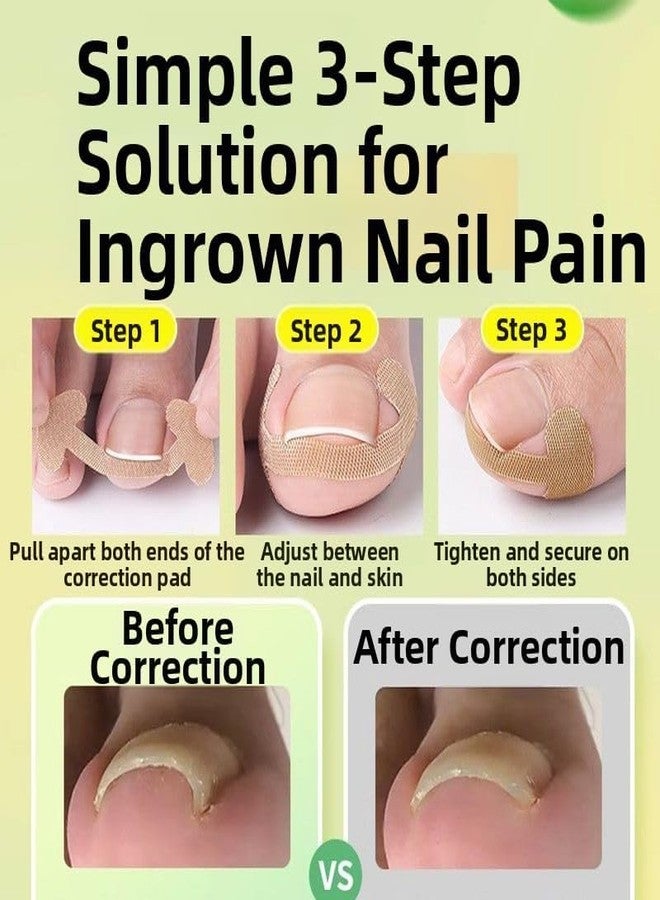 مجموعة ماديا المكونة من 5 قطع (20 شريطًا) لتصحيح الأظافر الغائرة والمنحنية، أداة للعناية بالقدمين، مشبك أظافر، ضمادات تصحيحية لعلاج الأظافر الغائرة، أداة رفع أظافر غير مؤلمة للنساء والرجال - Image 3