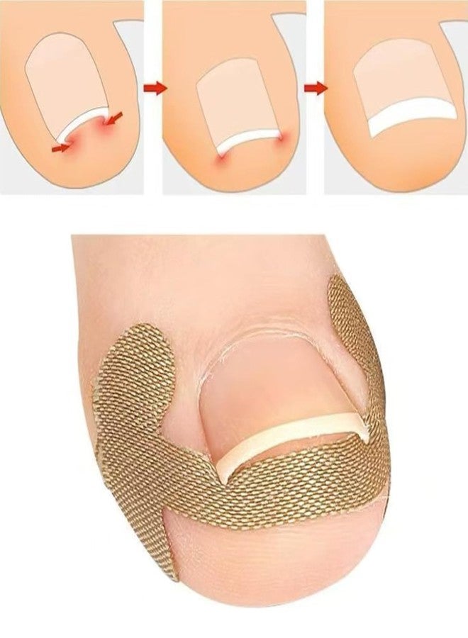 مجموعة ماديا المكونة من 5 قطع (20 شريطًا) لتصحيح الأظافر الغائرة والمنحنية، أداة للعناية بالقدمين، مشبك أظافر، ضمادات تصحيحية لعلاج الأظافر الغائرة، أداة رفع أظافر غير مؤلمة للنساء والرجال - Image 5