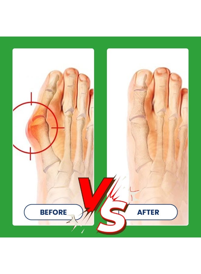 سوميفون كريم تدليك المفاصل لعلاج النقرس، كريم العناية بالبروز العظمي 20 جرام - Image 4