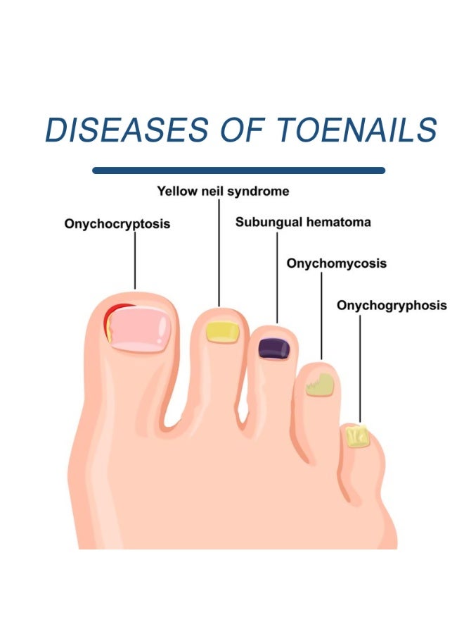 Comprehensive Nail Therapy System - Treatment for Yellowing, Ingrown, and Brittle Nails,mini body easy to carry - Image 4