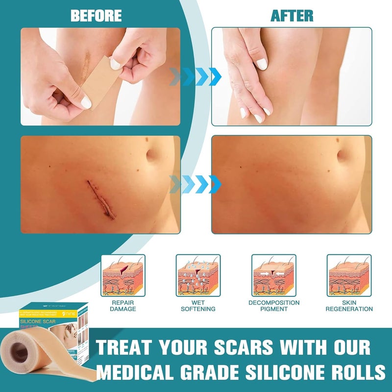Nine Silicone Scar Sheets 16x120 Roll3MSilicone Scar Tape RollScar Silicone StripsUltrathin Scar Removal Treatment for Surgical Scars C Section Tummy Tuck Keloid Bump Removal - Image 4