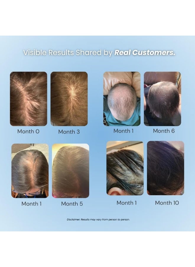 جروبليكس رغوة Growplex Vitafoam بتركيز 5% من المينوكسيديل للرجال والنساء، تركيبة للرجال تساعد على الحد من تأثير DHT، غير دهنية وسريعة الجفاف للمساعدة على إعادة نمو الشعر - Image 3