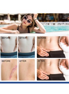 ALIVER Silicone Scar Sheets 4cm x 3m Silicone Scar Tape Roll Scar Silicone Strips Reusable Professional Scar Removal Sheets for C-Section Surgery Burn Keloid Acne Scar Sheet  - Image 4