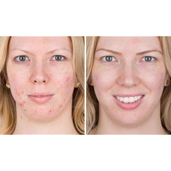 Cicamed Moisturizer for Acne, Cicamed Medical Science, ASD Active Acne Scars Blemishes Oily Skin and Discoloration - Image 2