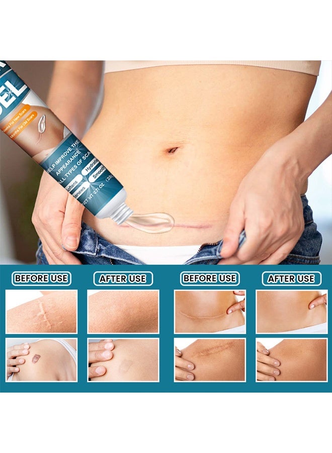 ERAYCEE Scar Gel 20g Effective In Treating Scars C-Section Scars Stretch Marks Acne Surgery Burns Effective On Old And New Scars - Image 3